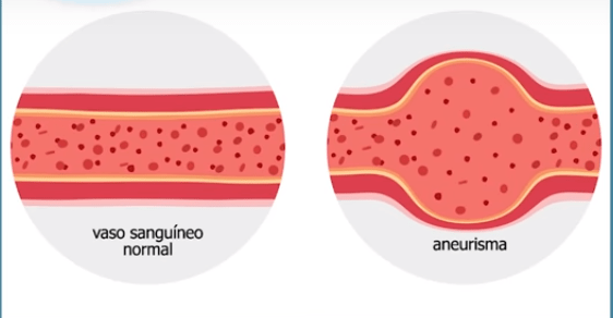 O aneurisma de aorta é uma dilatação em uma parte de um vaso sanguíneo: quando há um aumento do tamanho do vaso