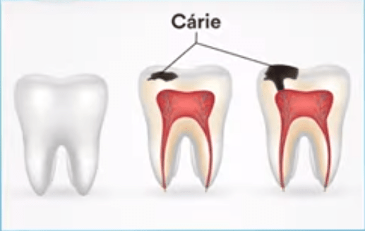 A cárie dentária inicia como manchas brancas nos dentes, que podem evoluir para pontos pretos.