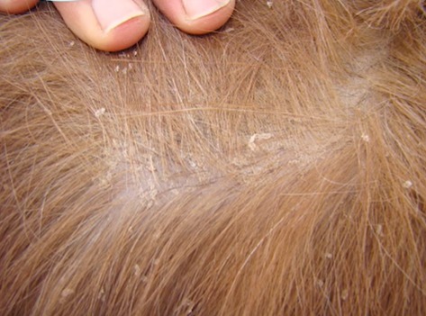 No couro cabeludo a dermatite é chamada de caspa