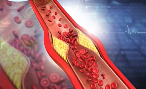 Triglicerideos alto é risco para doenças cardiovasculares