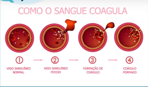 Quando há um desequilíbrio na coagulação, pode surgir a trombose