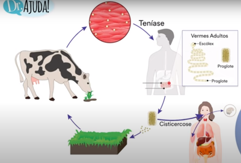 O consumo de carne de porco contaminada com as larvas da Tenia resulta em uma condição chamada de Teníase. 