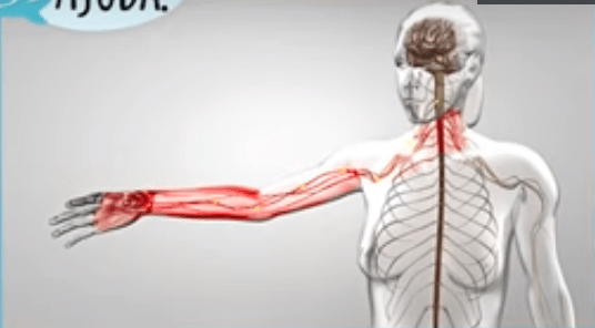 A dor no pescoço pode irradiar para o braço e até a mão.