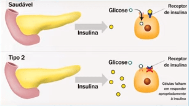 O diabetes tipo 2 se desenvolve gradualmente a partir de uma resistência à ação da insulina