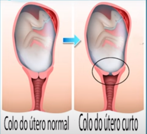 O colo de útero curto é um dos principais fatores de risco