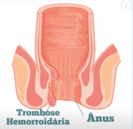 Caroço ou nódulo pode ser trombose hemorroidária.