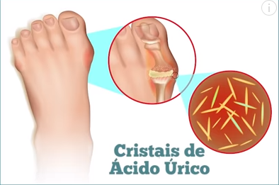 Os sintomas da gota ocorrem nos tecidos em que os cristais se formam.