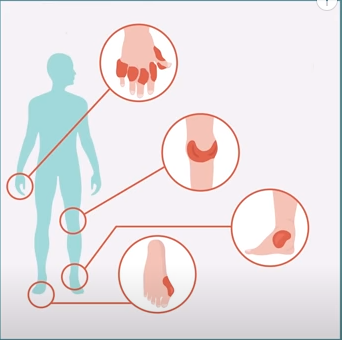 Os pés, tornozelos, joelhos, mãos e cotovelos são as articulações mais atingidas.