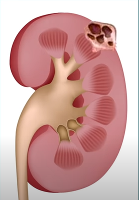 Quanto mais presentes estão esses achados, maior as chances desse cisto ser um tumor sólido cístico.