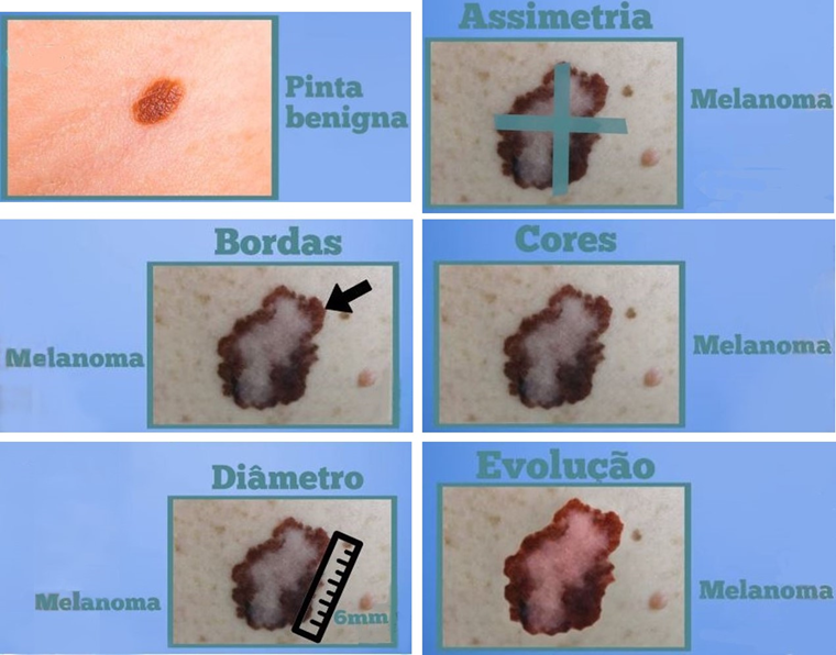 Tipos de câncer de pele