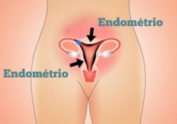 Muitas mulheres sofrem com endometriose.