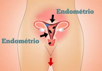 Se não há gravidez, o endométrio se solta do útero causando sangramento .