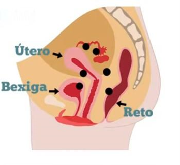 Esse sangue, misturado com células do endométrio, pode irritar os órgãos ao redor e assim desencadear um processo de inflamação no local.