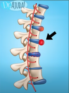 As estruturas que compõem a coluna também sofrem um desgaste e estão ligadas à causas de torcicolo.