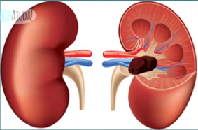 Carcinoma de células transicionais.