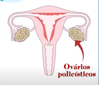 A síndrome dos ovários policísticos também podem desencadear câncer de endométrio.