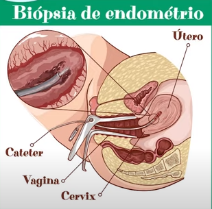 A biópsia é simples e feita no consultório médico.