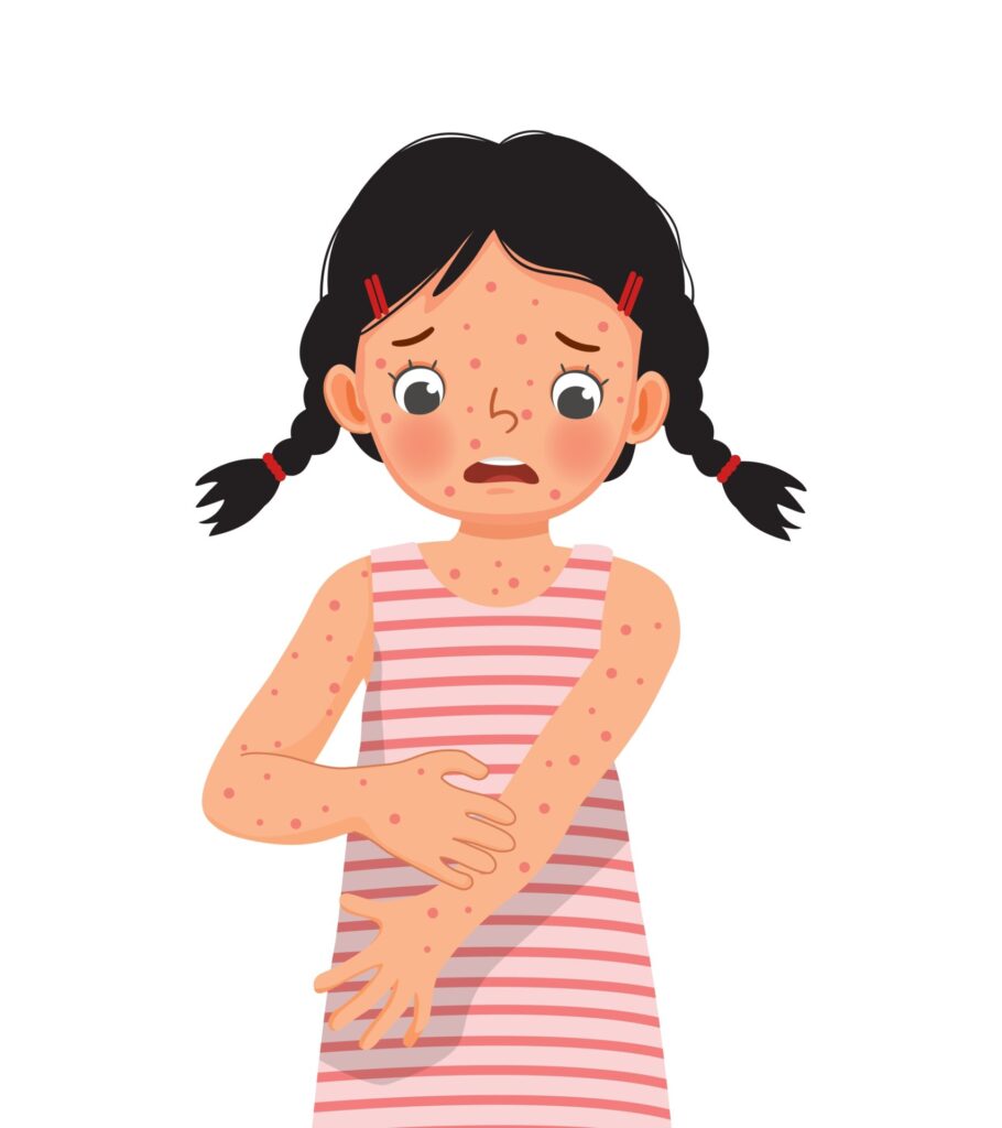 Cute,Little,Girl,Scratching,Her,Itchy,Arm,Suffering,From,Measles