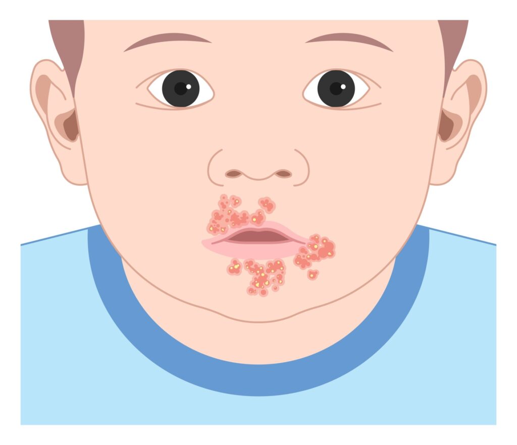 Impetigo,Oral,Poison,Ivy,Sepsis,Bacterial,Children,Dermatitis,Disease,Warts