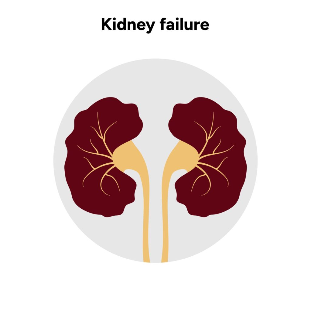 Kidney,Failure.,Medical,Kidney,Disease
