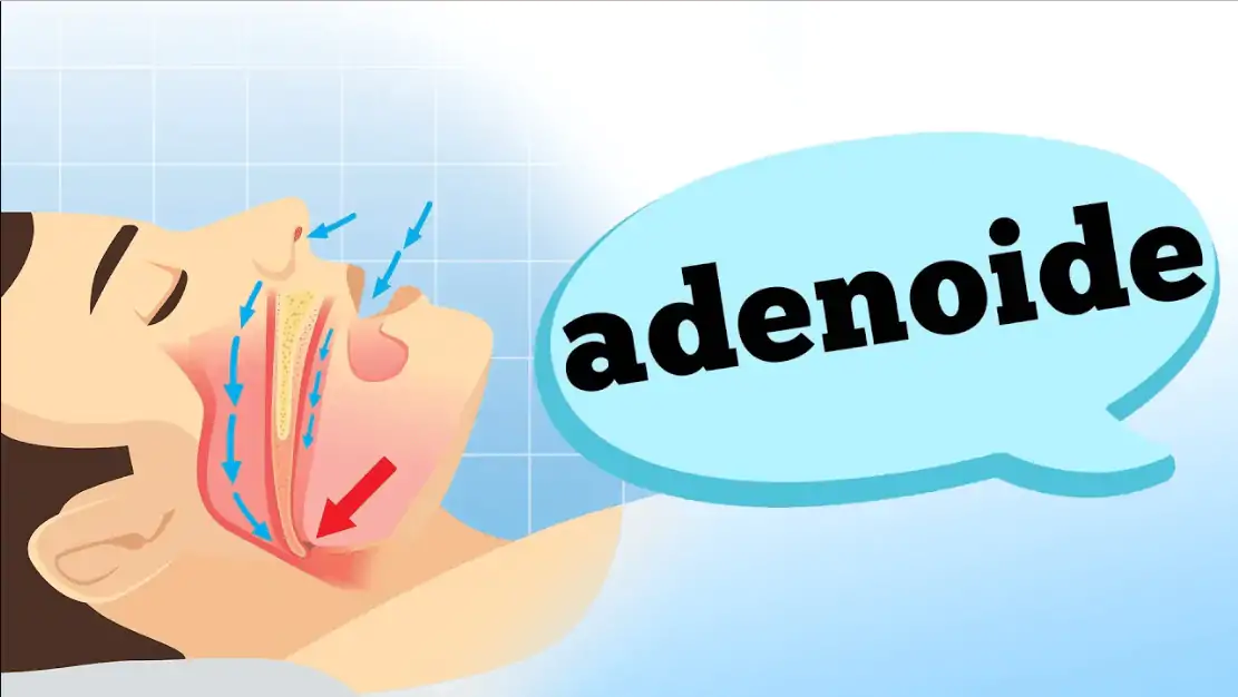 adenoide
