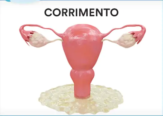 A vaginose bacteriana causa corrimento acinzentado, esverdeado e esbranquiçado
