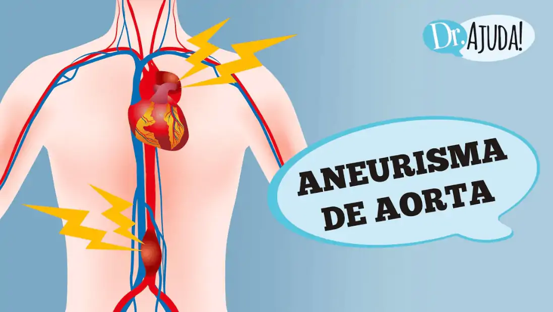 aneurisma de aorta