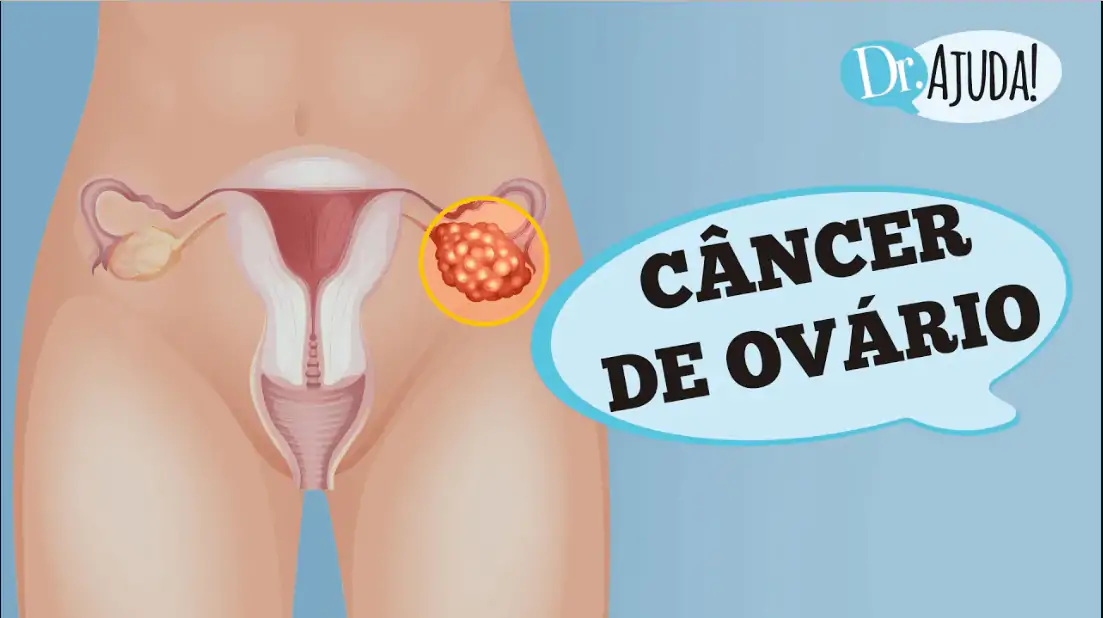 cancer de ovario