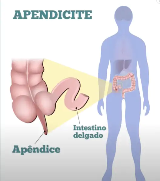 A apendicite aguda é uma inflamação do apêndice cecal, um pequeno órgão no início do intestino grosso