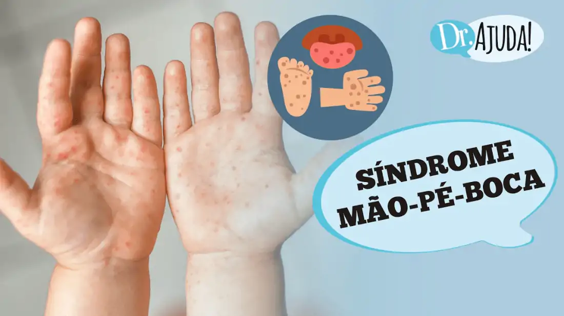 sindrome mao pe boca