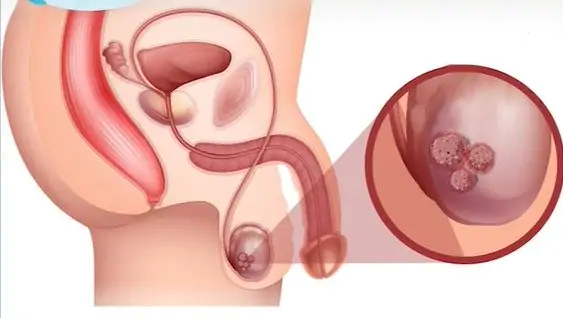 A dor não é um sintoma dominante no câncer de testículo; em vez disso, o tumor causa desconforto. 