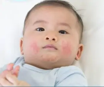 Normalmente, a dermatite atópica tem início na infância