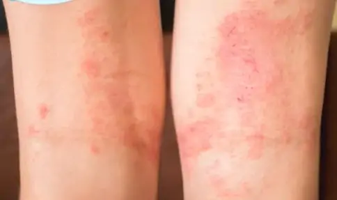 A intensidade da crise pode variar, abrangendo quadros leves, moderados ou graves.