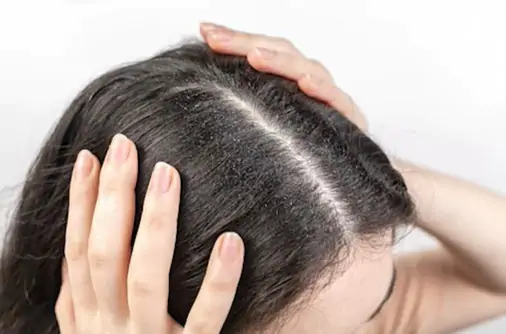 Não durma com o cabelo molhado e não use condicionar no couro cabeludo