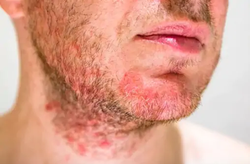 Alguns homens também podem ter na barba