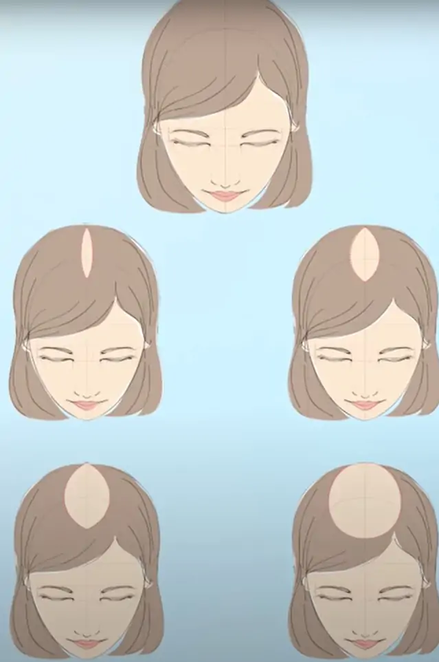 A queda de cabelo pode ter diversas causas