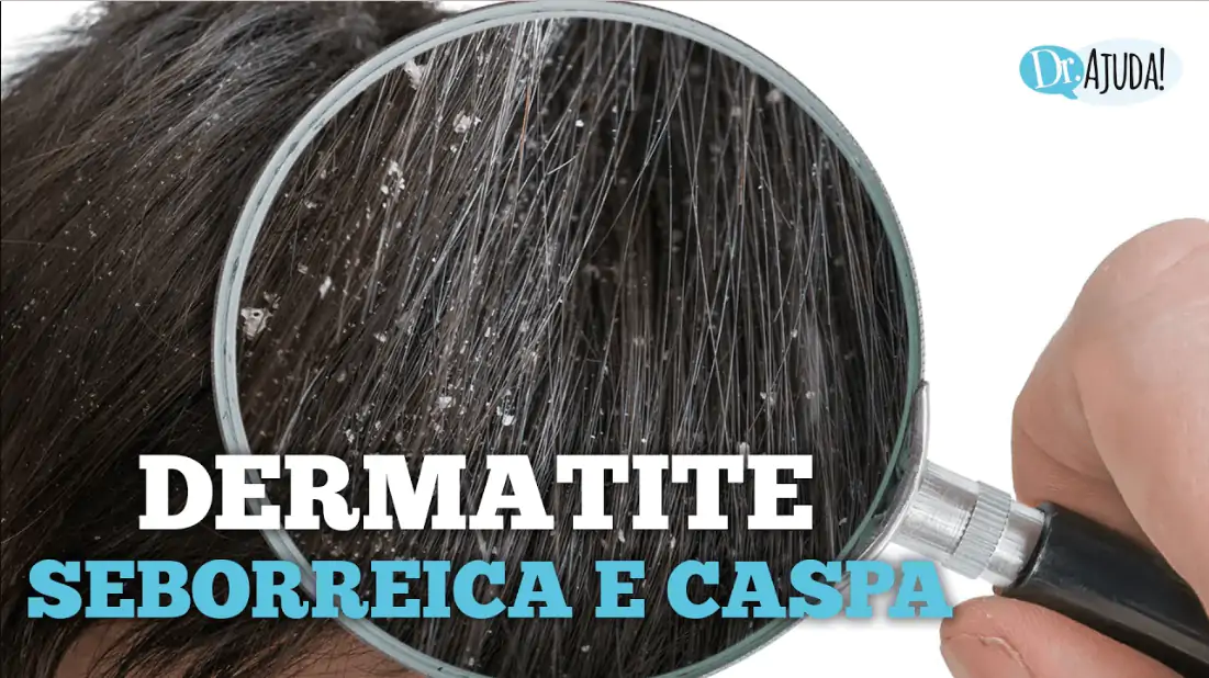 dermatite seborreica