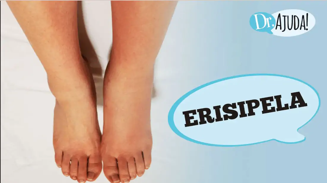 erispela