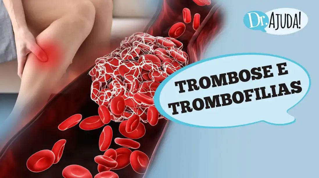 trombose