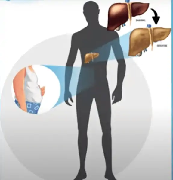 A gordura no fígado não costuma causar sintomas