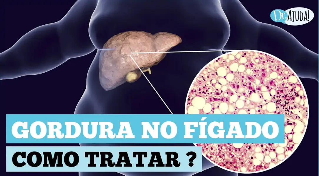 Gordura no figado