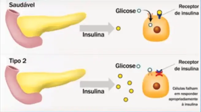 O diabetes tipo 2 se desenvolve gradualmente a partir de uma resistência à ação da insulina