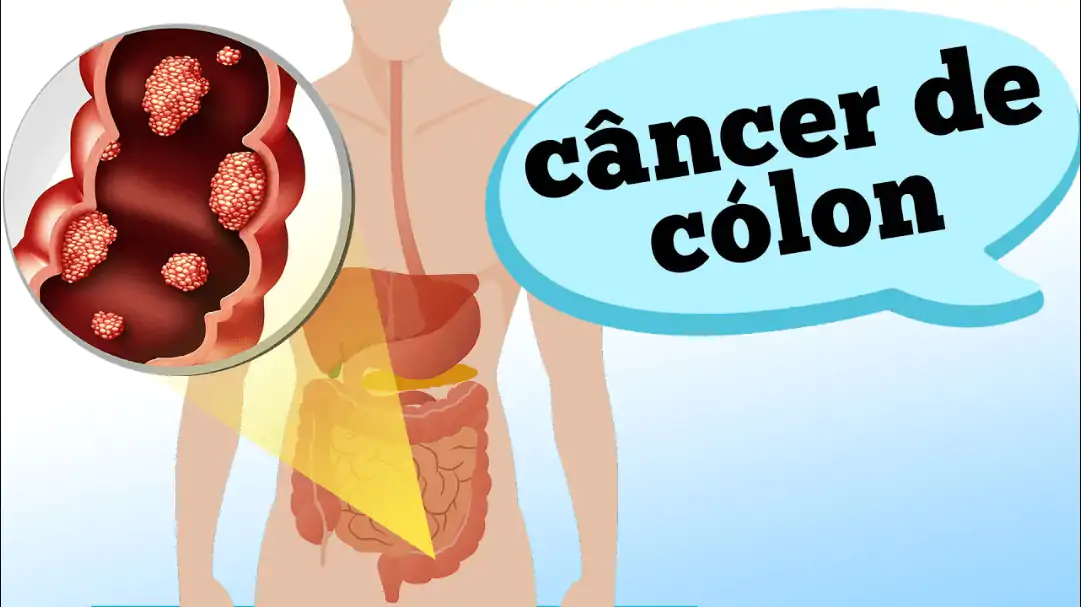 cancer de colon