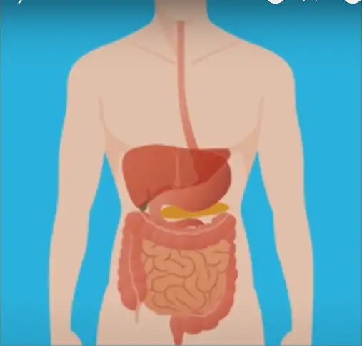 Câncer de cólon, ou câncer de intestino grosso, é um dos tumores mais frequentes