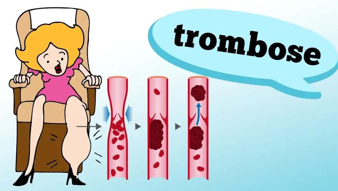 trombose