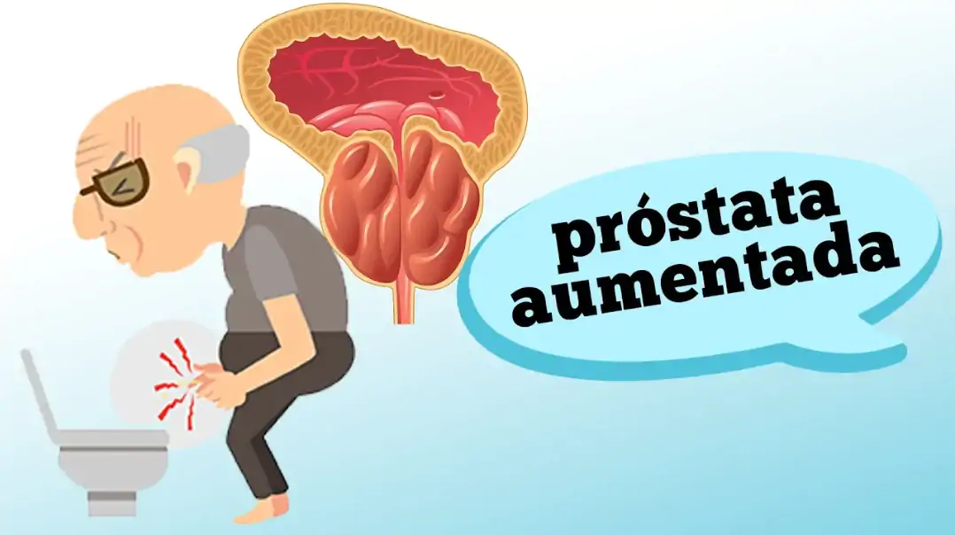 Hiperplasia Prostatica benigna
