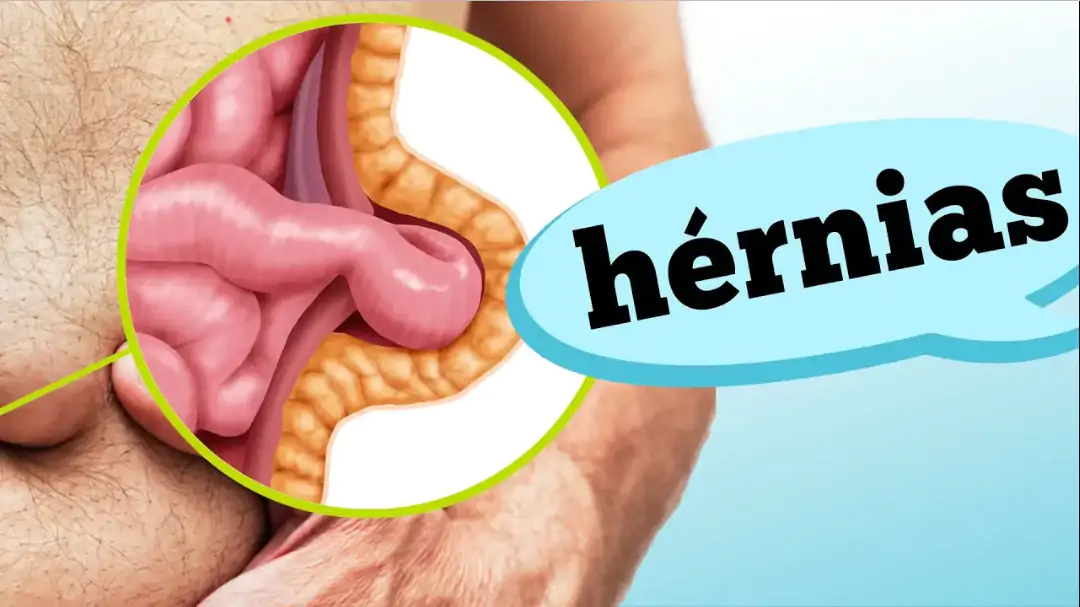 hernia