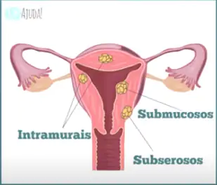 A localização do mioma pode causar sintomas diferentes.