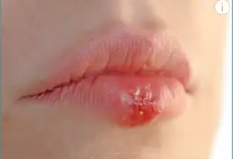 O aparecimento de bolhas é um sintoma comum.