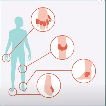 Os pés, tornozelos, joelhos, mãos e cotovelos são as articulações mais atingidas.